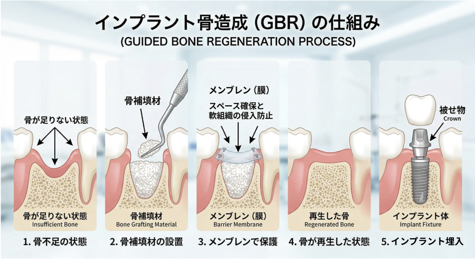 インプラントの骨造成(GBR)の仕組みを解説するイメージ図