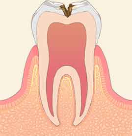 C2：象牙質に達する虫歯