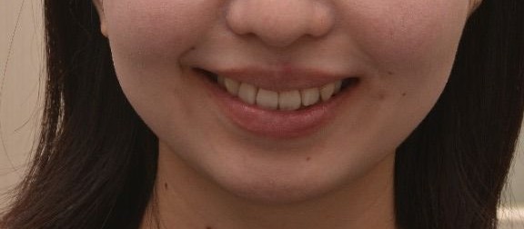 治療後の口元