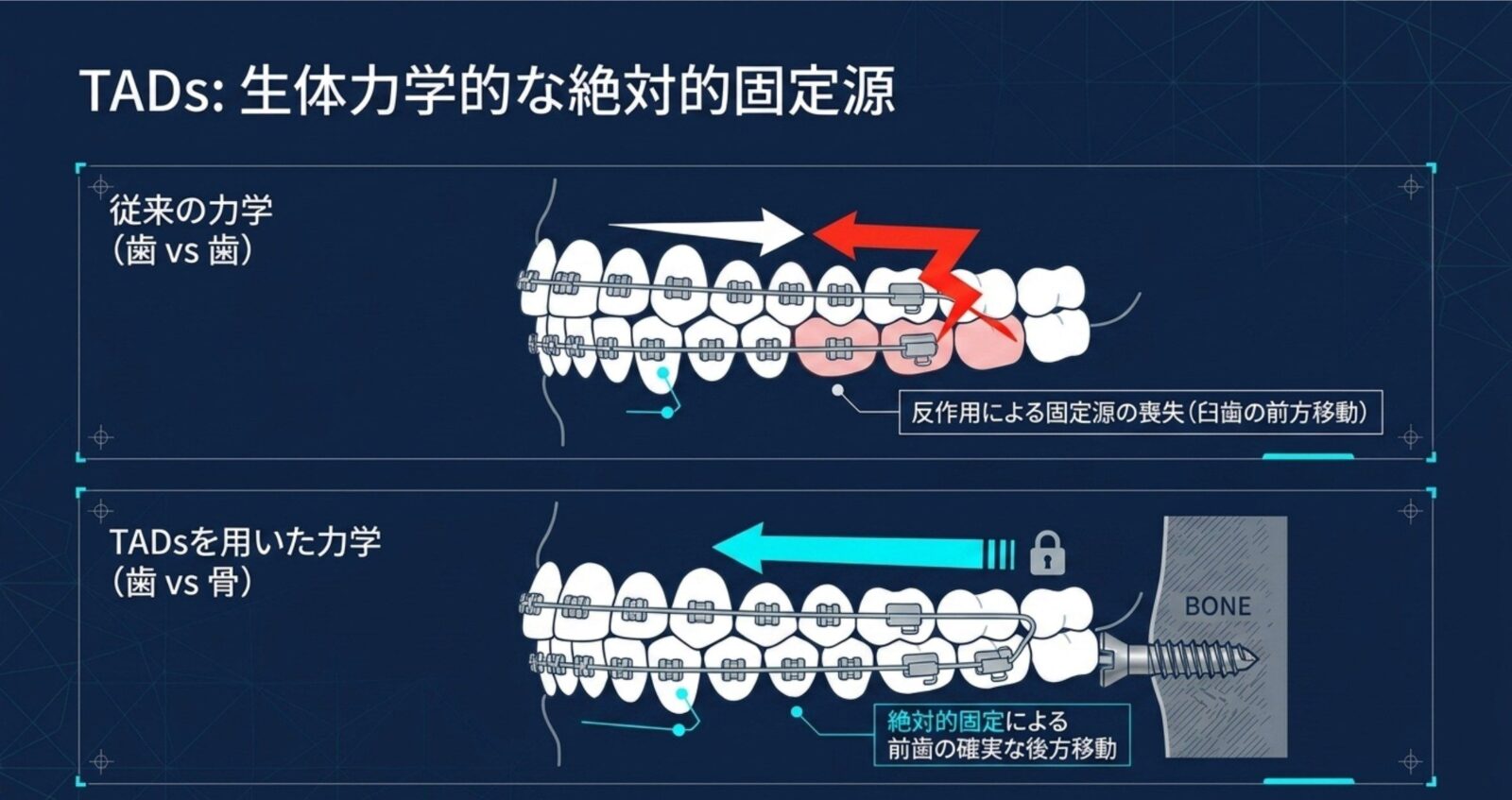 歯を支点にした場合と骨を支点にした場合の力のかかり方を比較した図