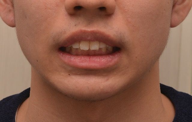 治療後の口元