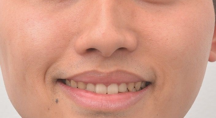 治療後の口元