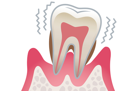 歯周病の問題点
