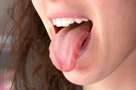 Q.舌が白いのはなぜ？病気？