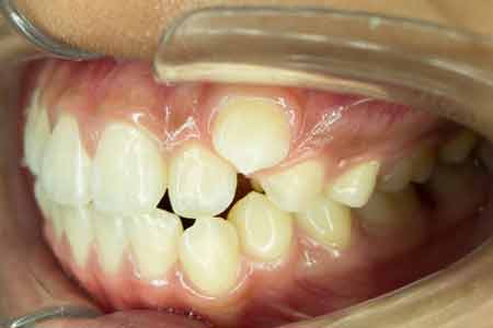 歯並びが悪いと何か影響があるの？
