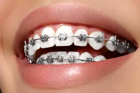 歯科矯正の方法の種類