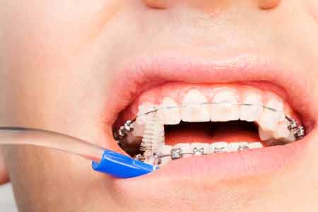 歯科矯正中の期間の過ごし方