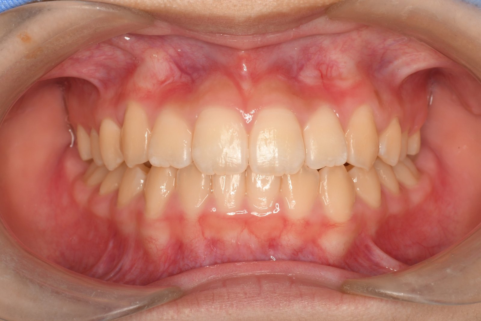 ortho01-front-after