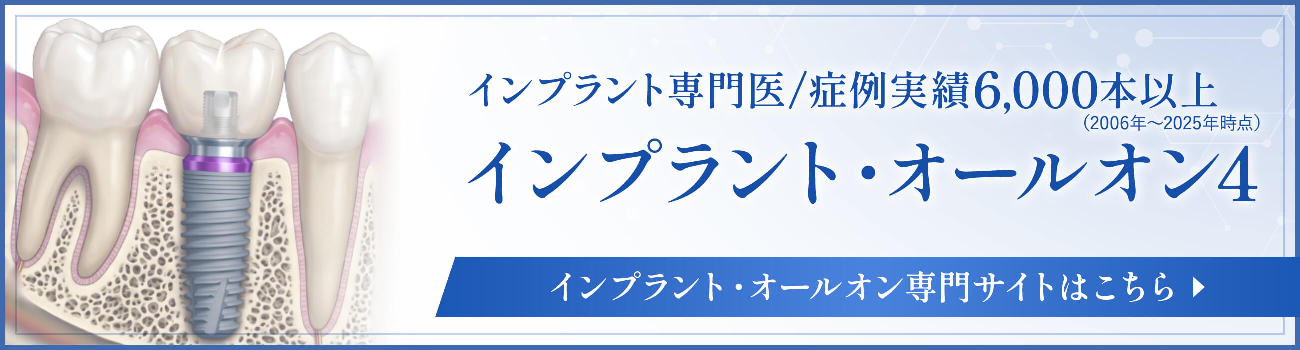 インプラント・オールオン4専門サイト