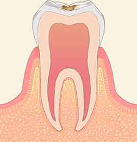C1：エナメル質に達する虫歯
