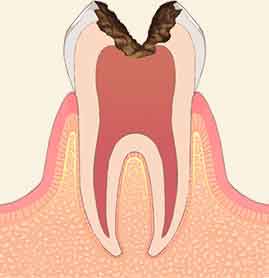 C3：神経に達する虫歯