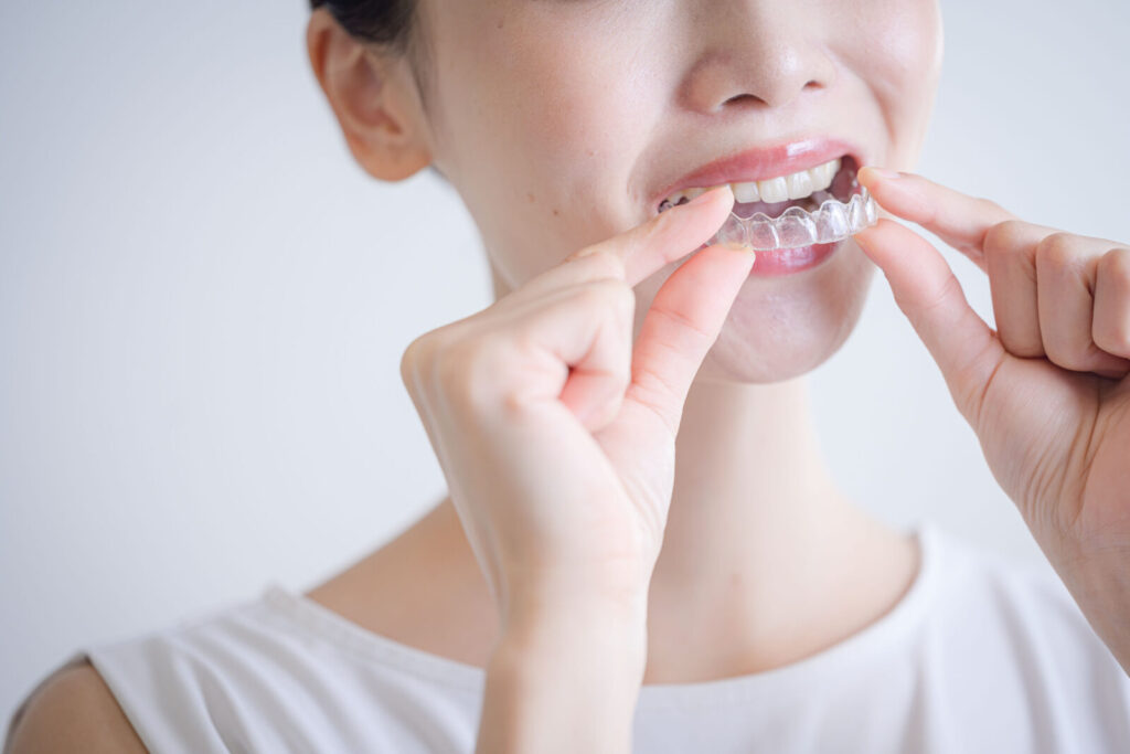 愛媛インプラントクリニックかまくら歯科にて、患者様がマウスピース型矯正装置を装着している様子。インプラント治療とマウスピース矯正を併用し、全体の歯並びと噛み合わせを整える包括的な歯科診療を行っています。愛媛県松山市で見た目の美しさと機能性を両立させた治療を提供しています。